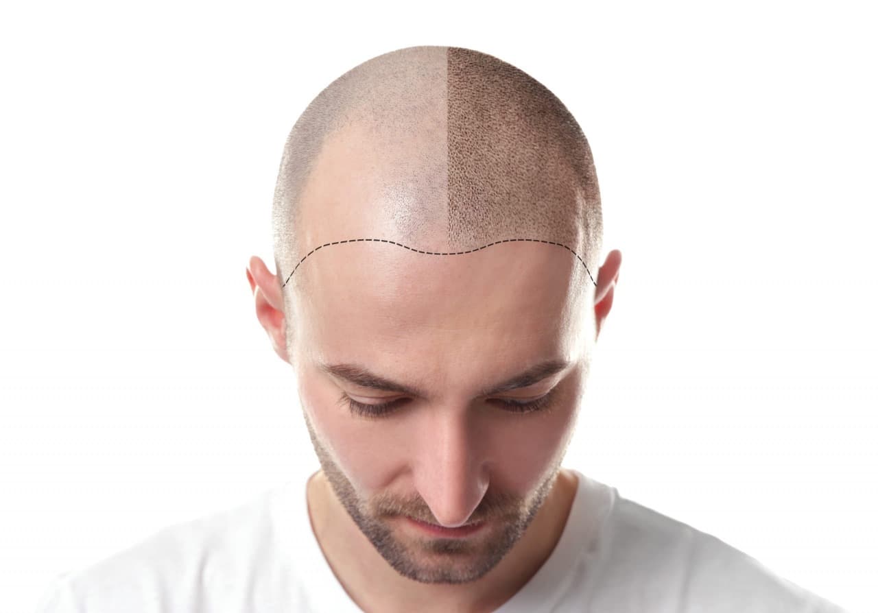 Hair Transplant London – Westminster Medical Group®’s Excellence in Every Strand