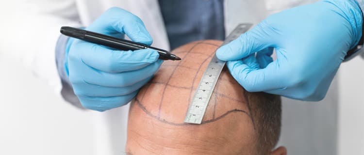 Hair Transplant Istanbul Treatment by Sapphire Hair Clinic